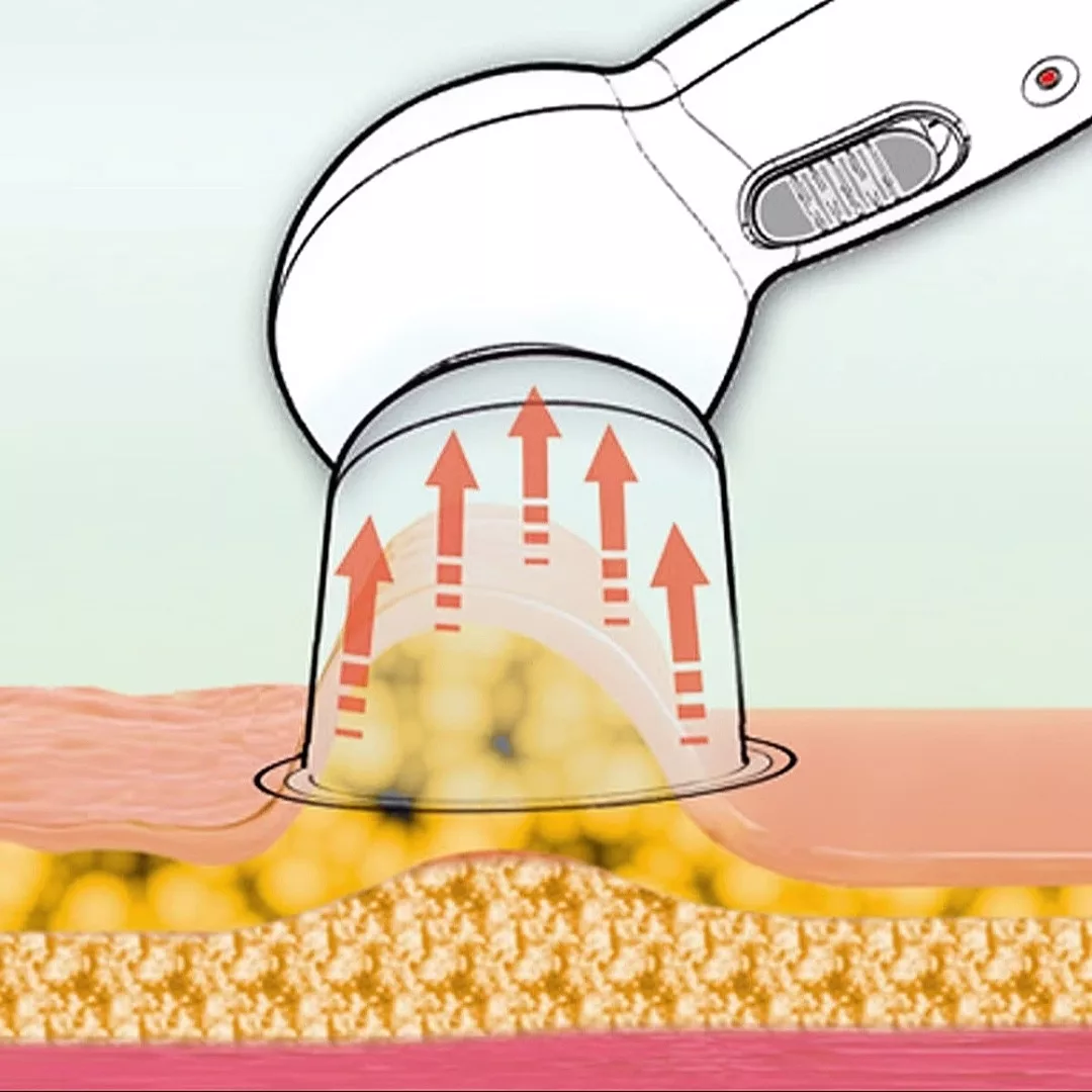 ماساژور برقی ام کیو پرفکت مدل بادکش کد AA